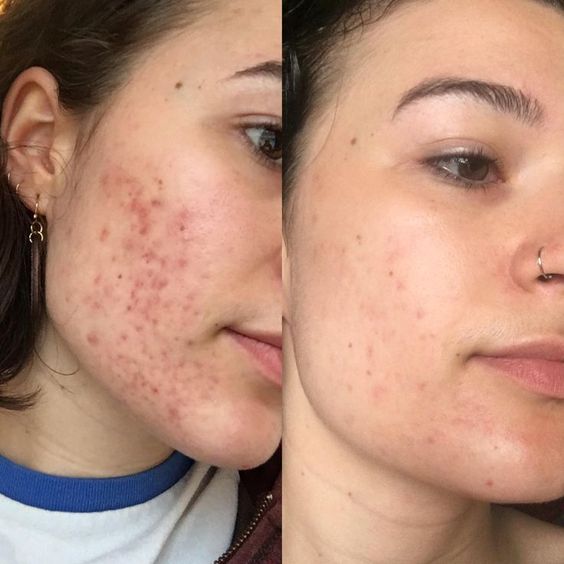 SERUM 10 ÁCIDO SALICÍLICO | ELIMINA ACNE E IMPERFECCIONES